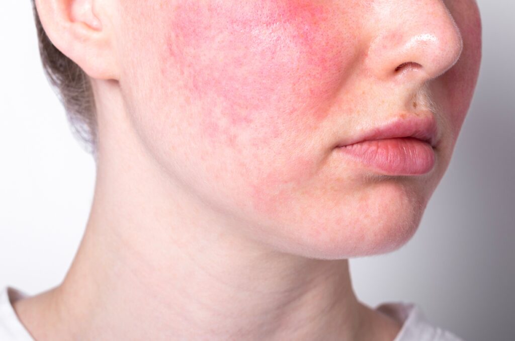 Rosacea