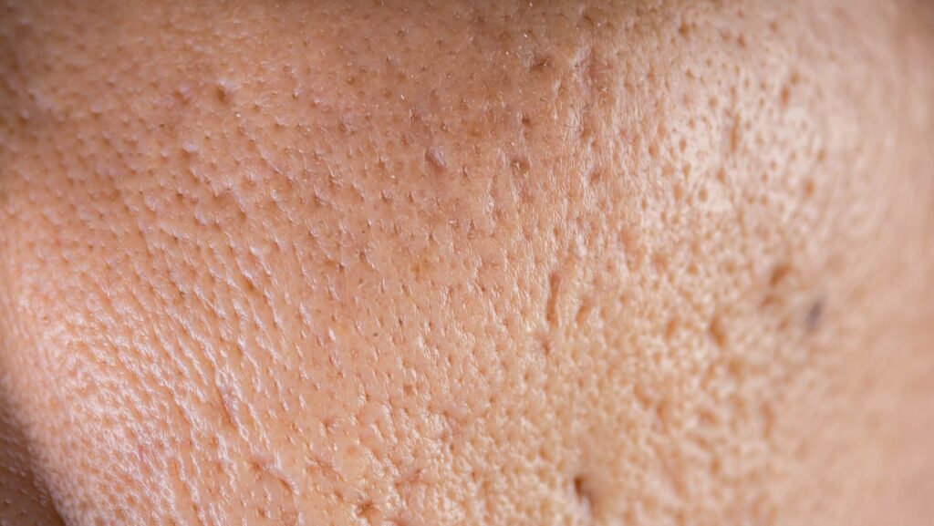 acne